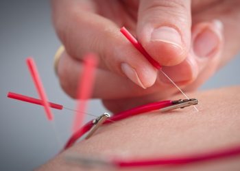 Detail image of Acupuncture with electrical stimulation