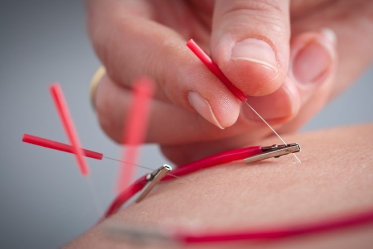 Detail image of Acupuncture with electrical stimulation